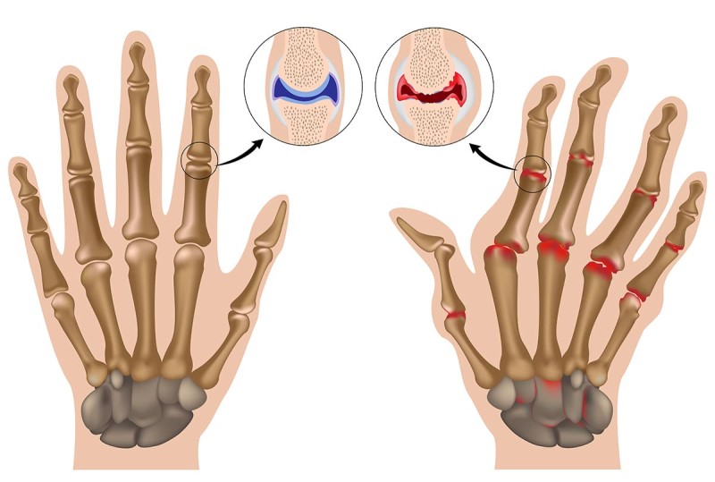 Thông tin về các loại thuốc điều trị viêm khớp dạng thấp