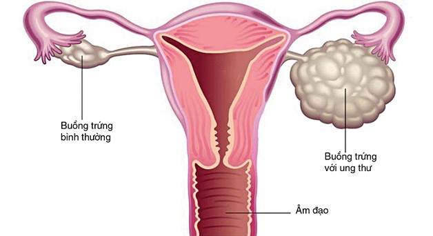 Thông tin về phẫu thuật điều trị ung thư buồng trứng