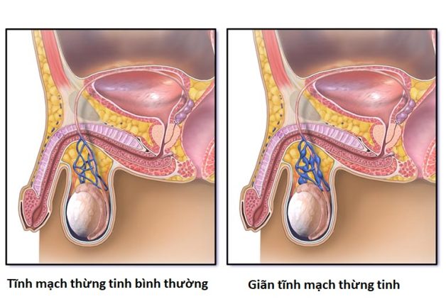 Thông tin về tình trạng bệnh giãn tĩnh mạch thừng tinh độ 1