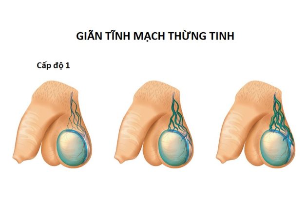 Thông tin về tình trạng bệnh giãn tĩnh mạch thừng tinh độ 1