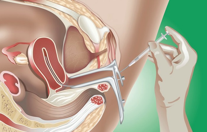 Thụ tinh nhân tạo IUI là gì và những điều cần biết