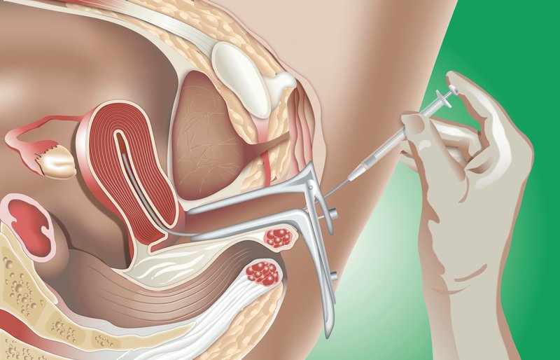 Thụ tinh nhân tạo và chi phí thụ tinh nhân tạo là bao nhiêu?