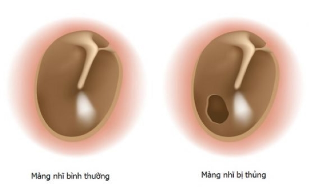 Thủng màng nhĩ có chảy máu nhiều không và khắc phục ra sao?