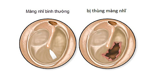 Thủng màng nhĩ có chữa được không? Giải đáp thắc mắc chung