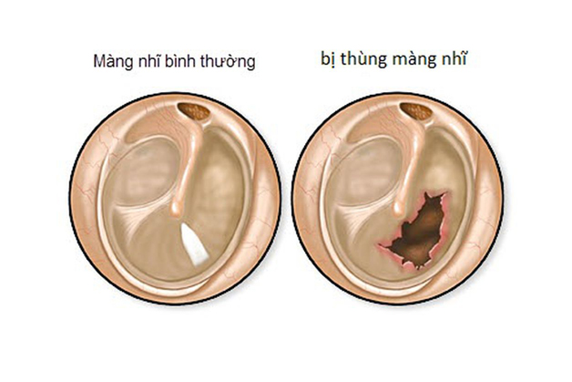 Thủng màng nhĩ và những điều cần biết