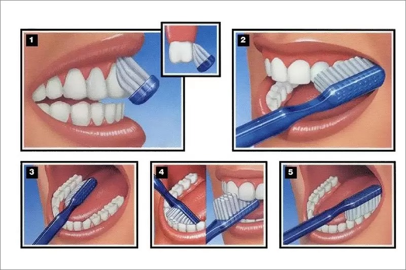 Thuốc bôi trị viêm nướu răng – Cách sử dụng an toàn, hiệu quả