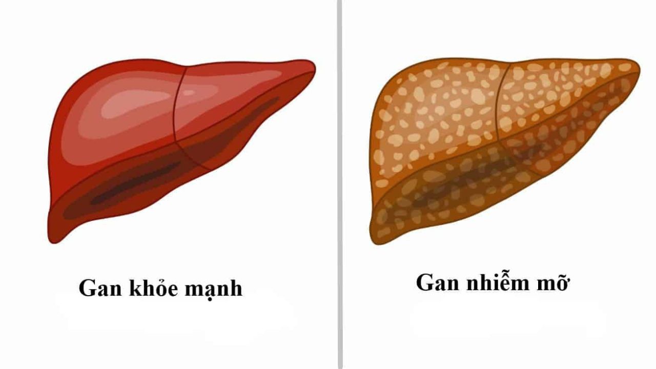 Thuốc cho bệnh nhân gan nhiễm mỡ và những lưu ý khi sử dụng