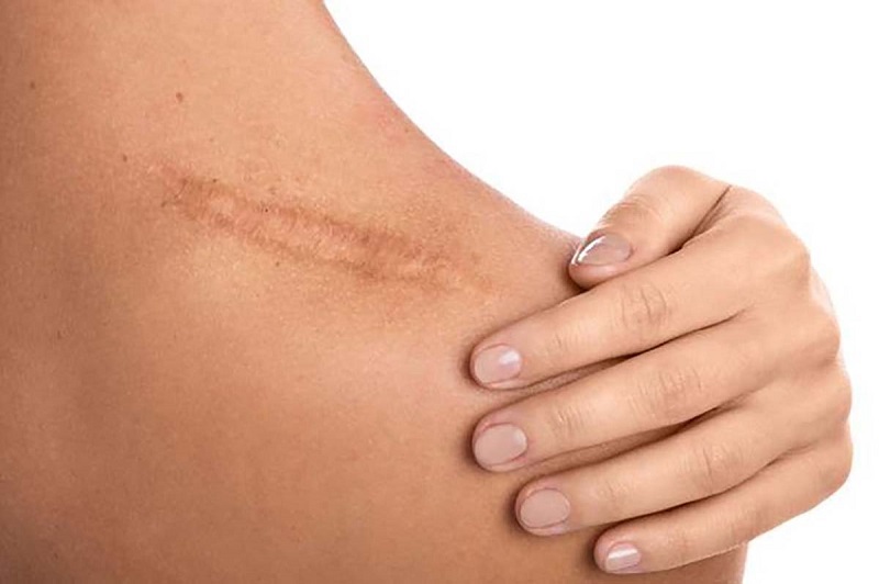 Thuốc trị sẹo Scar Esthetique: Công dụng và lưu ý sử dụng