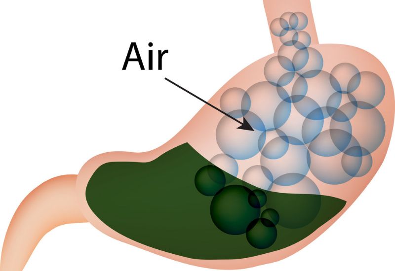 Thường xuyên ợ hơi: Hiểu rõ nguyên nhân, thời điểm thăm khám