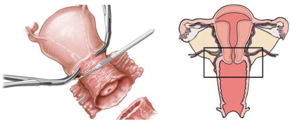 Tiêm thuốc chống ung thư cổ tử cung: bước tiến y học hiện đại