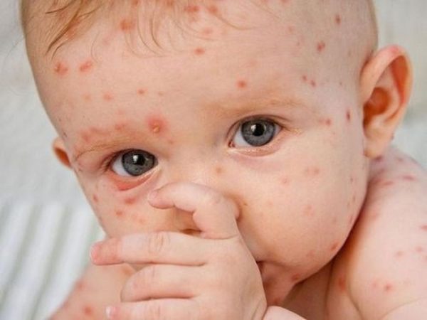 Tiêm vắc xin sởi – rubella miễn phí cho trẻ từ 1 đến 5 tuổi