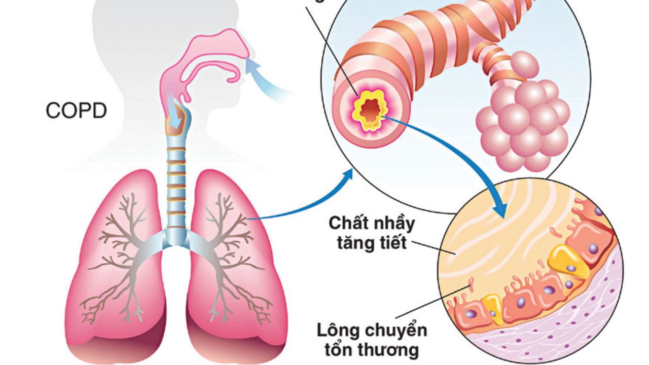 Tiên lượng bệnh tắc nghẽn phổi mạn tính và những điều cần biết