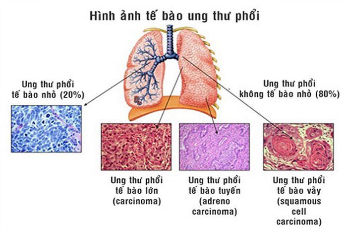 Tiên lượng bệnh ung thư phổi theo từng giai đoạn