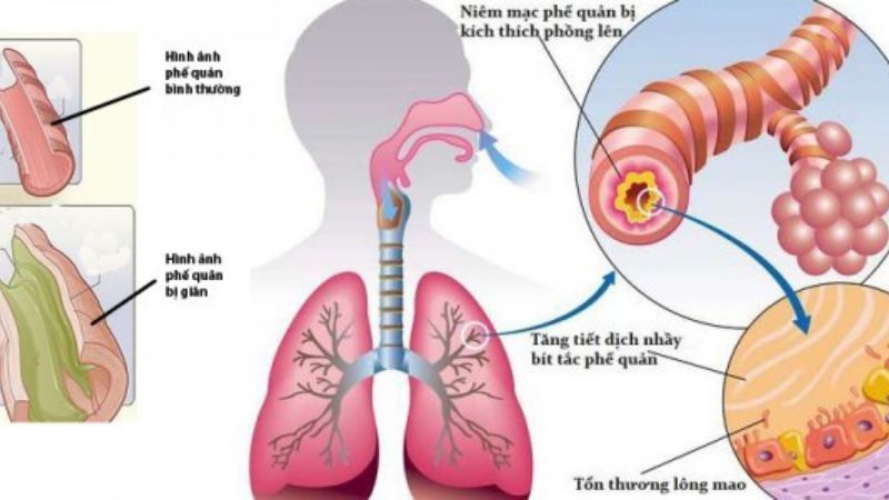 Tiên lượng của bệnh nhân giãn phế quản và cách điều trị