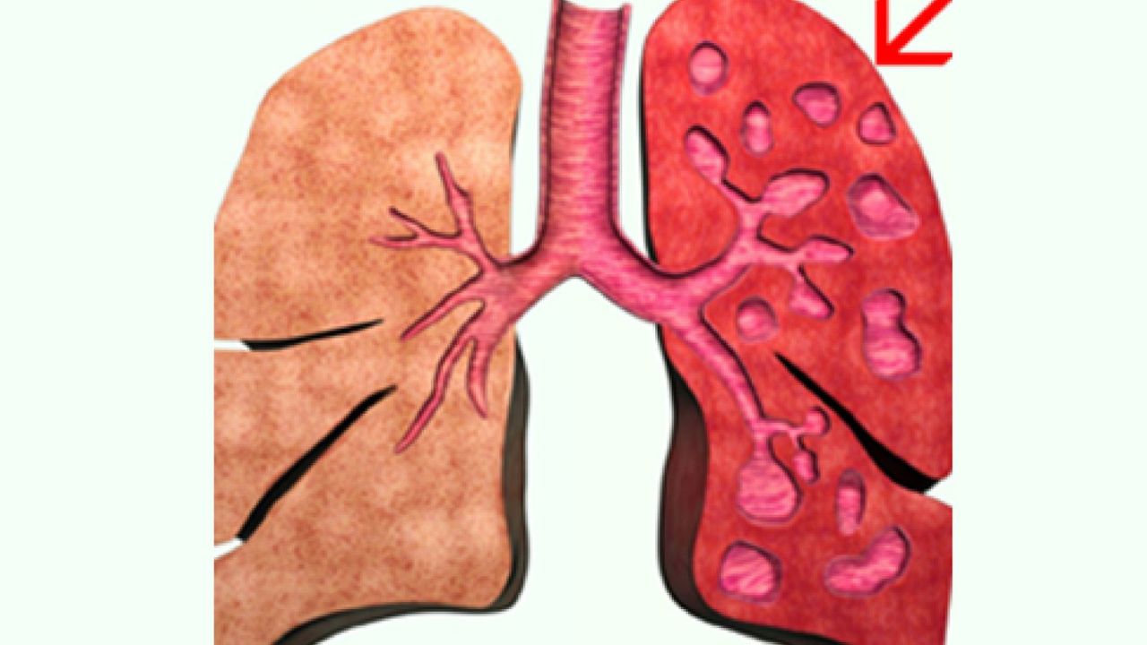 Tiên lượng của bệnh nhân lao màng phổi và điều cần biết