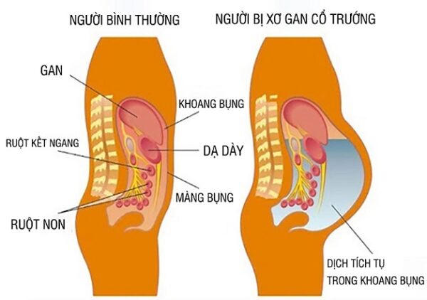 Tiếp xúc với người bệnh xơ gan cổ trướng có lây không?