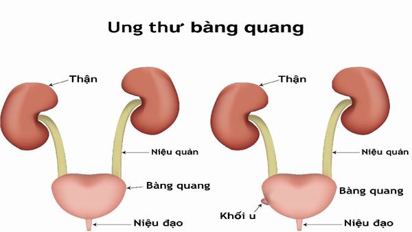 Tiết lộ các bệnh lý về bàng quang