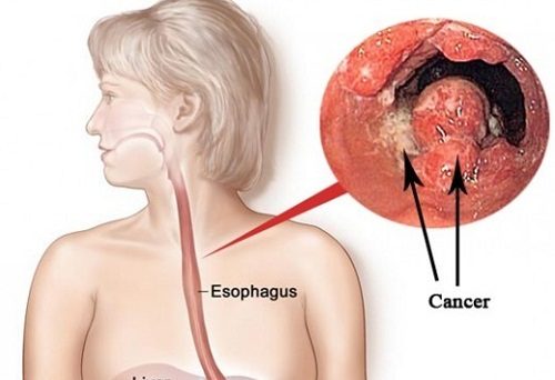 Tiết lộ triệu chứng thường gặp của bệnh ung thư thực quản