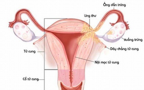 Tiểu buốt ở nữ giới nguyên nhân do đâu?