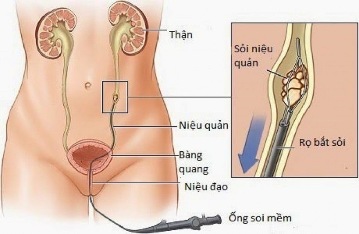 Tiểu ra máu sau tán sỏi niệu quản do đâu