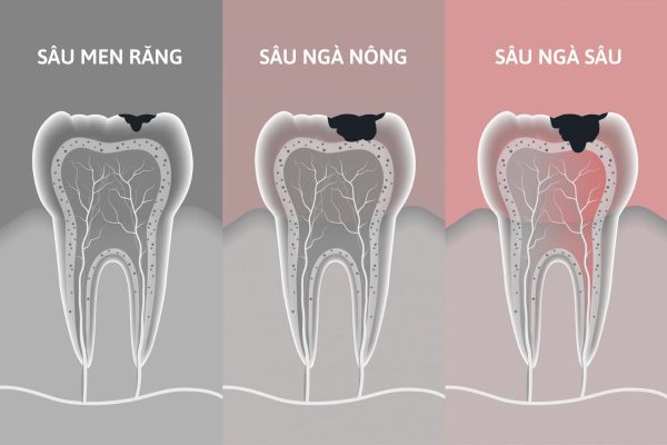 Tìm hiểu 3 mức độ sâu răng và cách điều trị