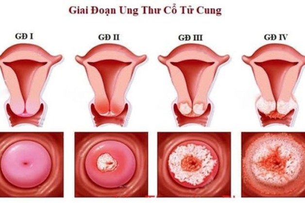 Tìm hiểu 4 cách tầm soát ung thư cổ tử cung phổ biến