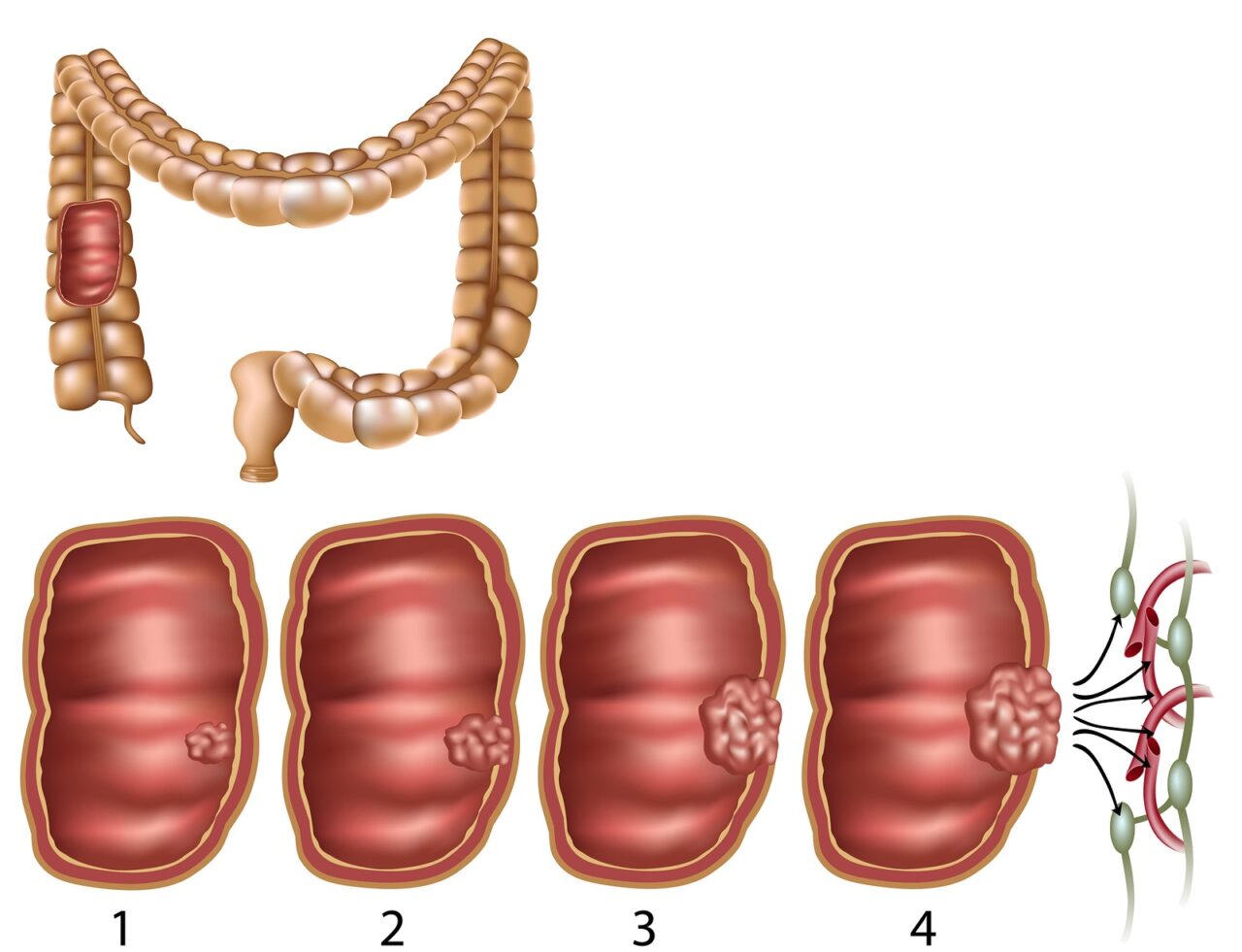 Tìm hiểu 4 giai đoạn của ung thư đại tràng