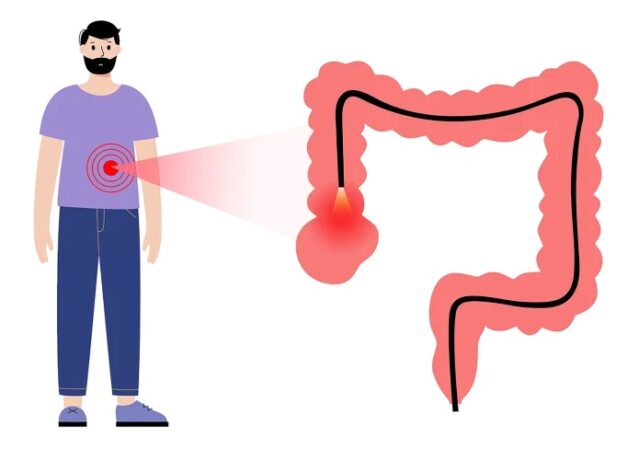 Tìm hiểu 4 giai đoạn của ung thư đại tràng