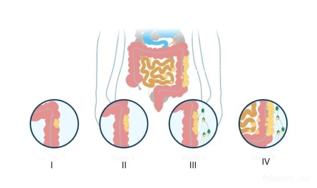 Tìm hiểu 4 giai đoạn của ung thư đại tràng