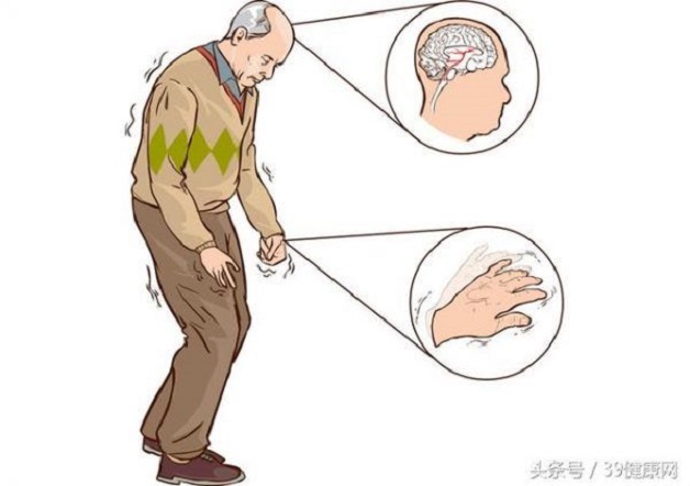 Tìm hiểu bệnh parkinson có di truyền không?