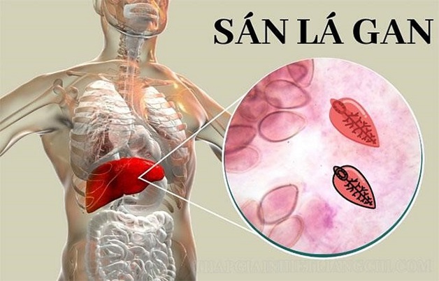 Tìm hiểu bệnh sán lá gan lớn và cách chẩn đoán