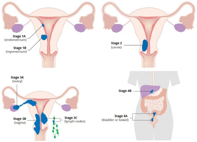 Tìm hiểu bệnh ung thư buồng trứng di căn ổ bụng