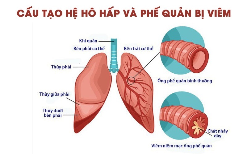 Tìm hiểu bệnh viêm phế quản có nguy hiểm không