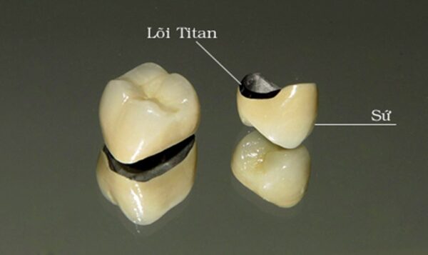 Tìm hiểu bọc răng sứ bao nhiêu tiền thì đẹp lại tốt