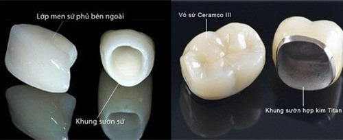 Tìm hiểu bọc răng sứ loại nào thì tốt, top 5 mão răng sứ cực đẹp