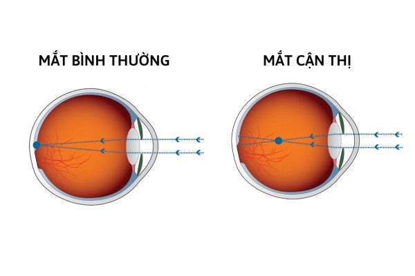 Tìm hiểu các tật khúc xạ về mắt thường gặp