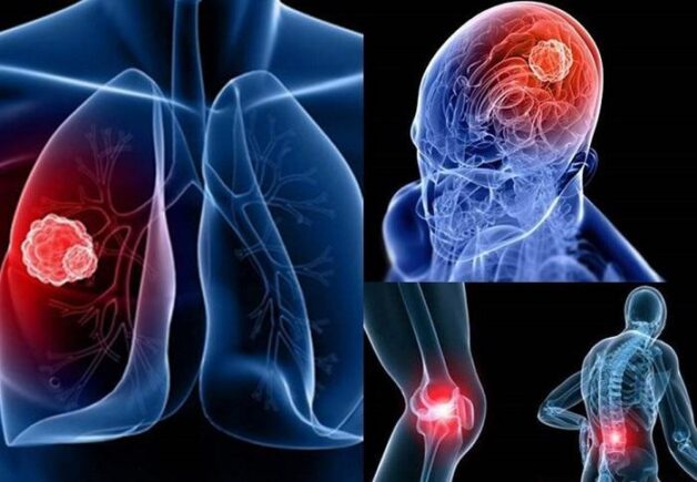 Tìm hiểu cách chữa ung thư phổi NSCLC di căn