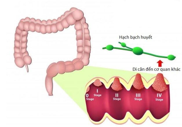 Tìm hiểu cách điều trị bệnh ung thư đại tràng