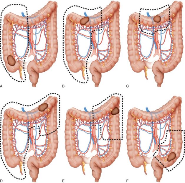 Tìm hiểu cách điều trị bệnh ung thư đại tràng