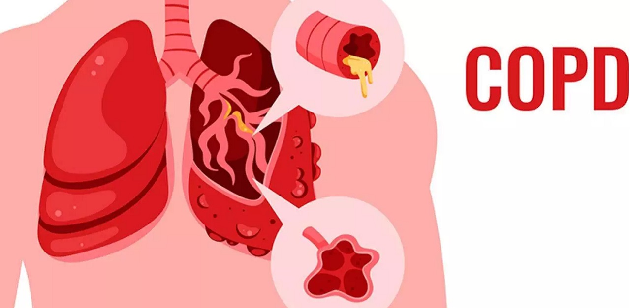 Tìm hiểu cách điều trị COPD hiệu quả