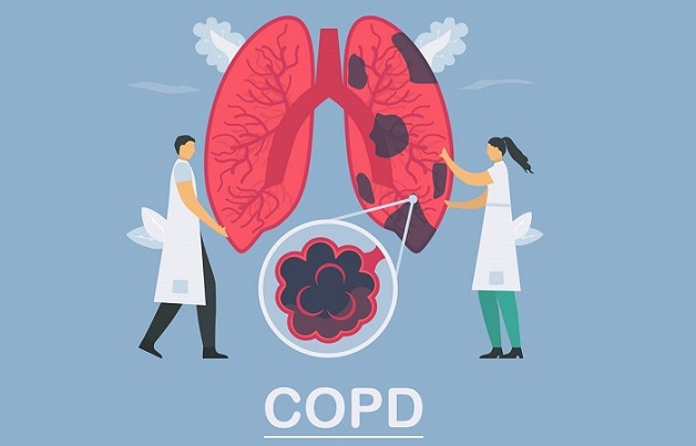 Tìm hiểu cách điều trị COPD hiệu quả