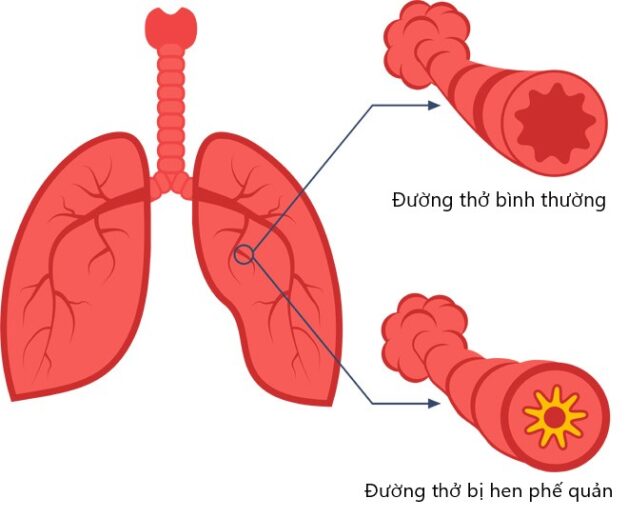 Tìm hiểu cách điều trị hen phế quản ở người lớn