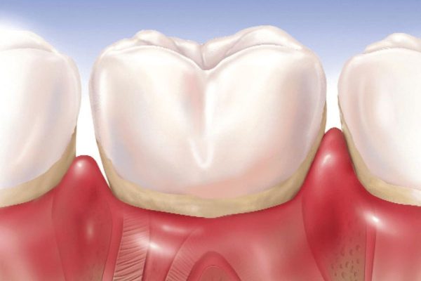 Tìm hiểu cách điều trị sưng nướu răng hiệu quả nhanh chóng