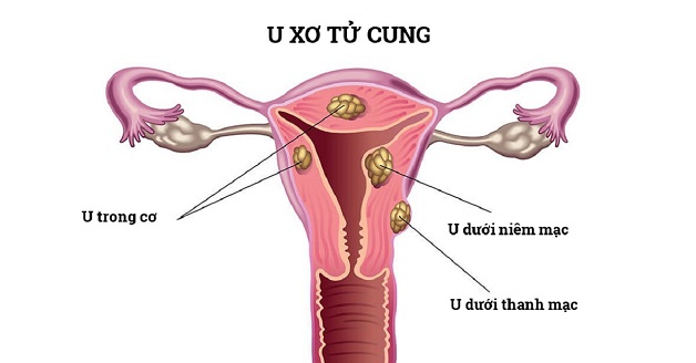 Tìm hiểu cách xử trí u xơ tử cung hiệu quả