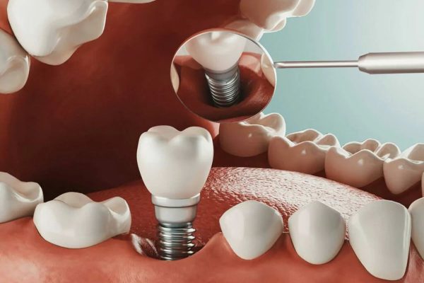 Tìm hiểu cấy ghép implant có an toàn không?