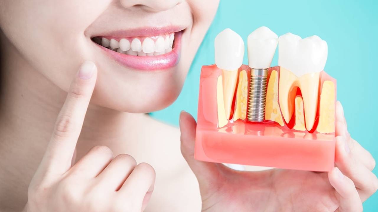 Tìm hiểu chi phí trồng răng implant