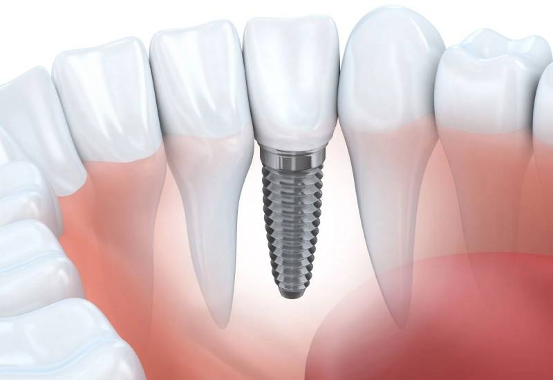 Tìm hiểu chi phí trồng răng implant