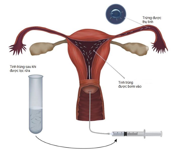 Tìm hiểu chi tiết kỹ thuật bơm tinh trùng vào buồng tử cung