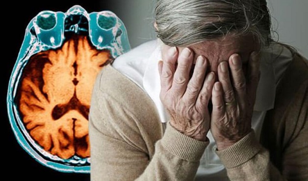 Tìm hiểu chi tiết triệu chứng bệnh Alzheimer