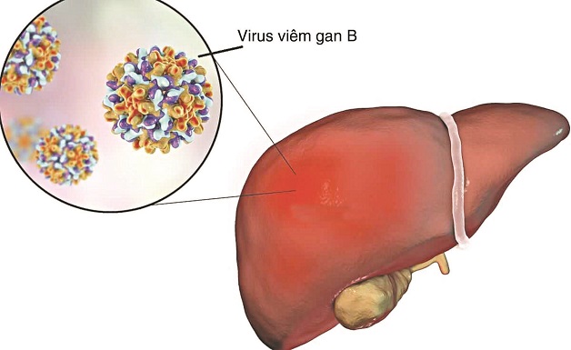 Tìm hiểu chồng bị viêm gan B có lây sang vợ không